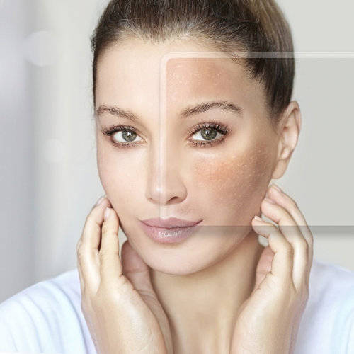 Melasma: sintomas, causas, tipos e melhores tratamentos para manchas na pele