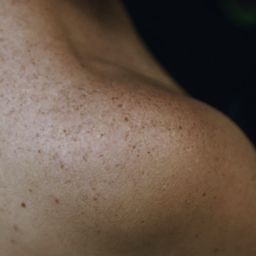 Manchas escuras na pele: causas, prevenção e como clarear de forma eficaz
